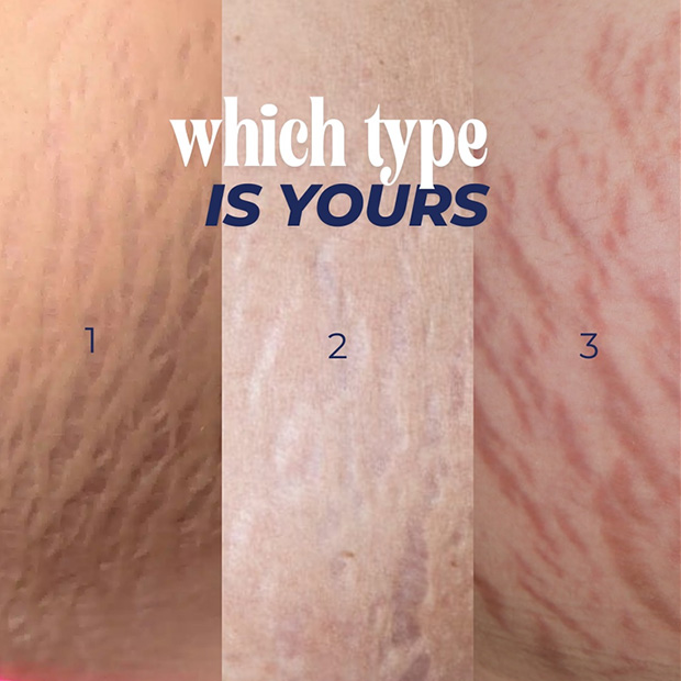Early Stretch Marks Treatment