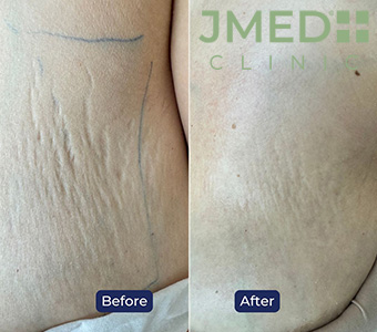 How To Remove Stretch Marks Fast?