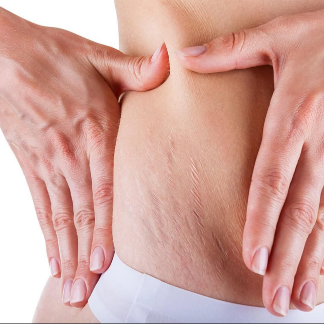 How To Fade Red Stretch Marks