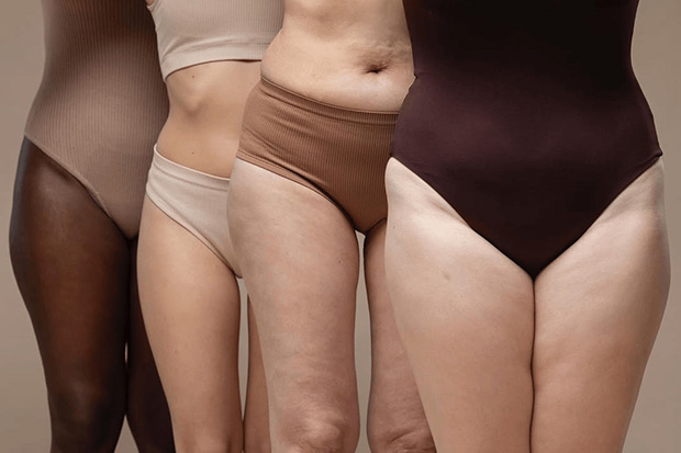 Sagging Skin Stretch Marks