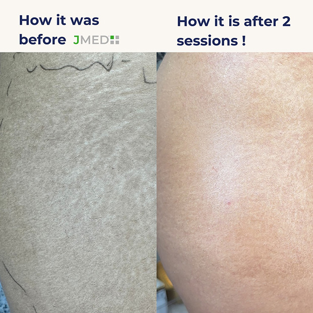 Stretch Mark Removal Before And After Pictures
