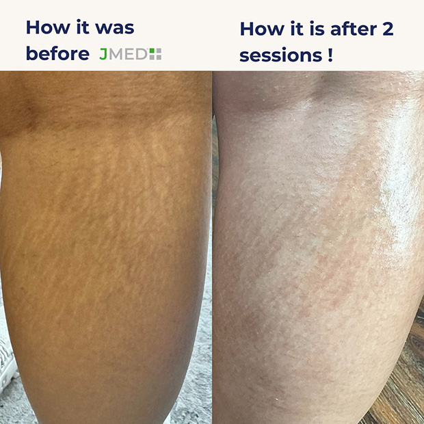 Stretch Mark Removal Before And After