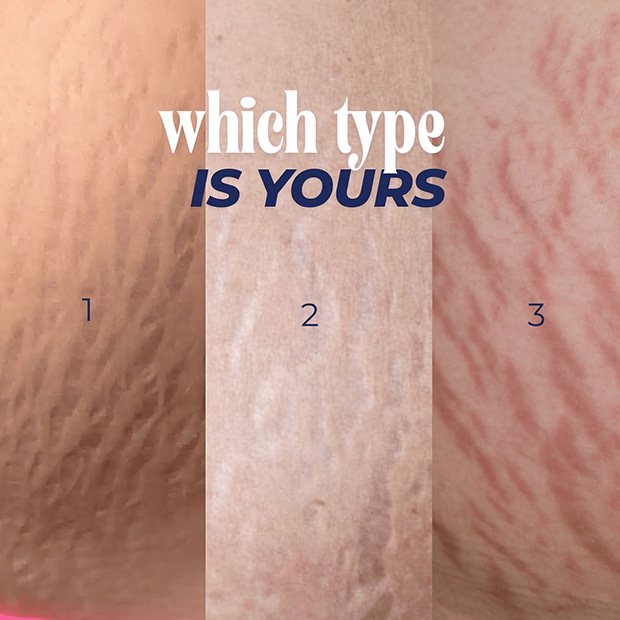 Stretch Marks Removal For Men