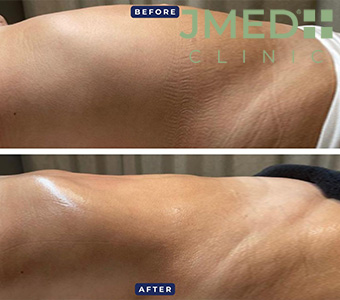 What are the Benefits of Stretch Marks Removal?