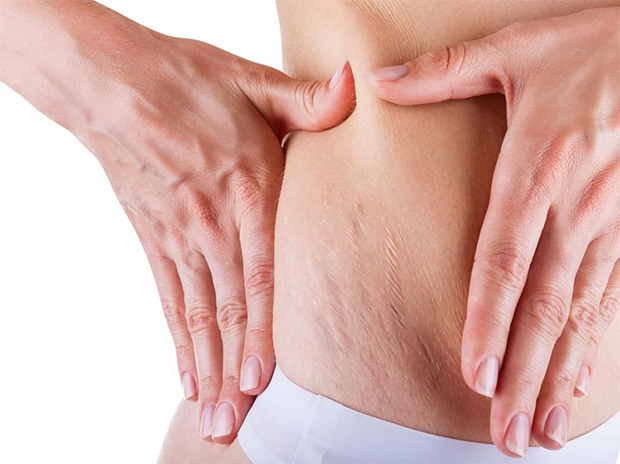 How To Treat White Stretch Marks