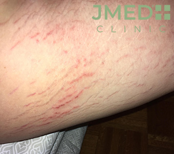 Why do I have so Many Stretch Marks On My Thighs?
